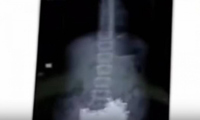 Βίντεο σοκ: Θύμα bullying κατάπιε καρφιά για να αυτοκτονήσει