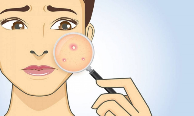 Ακμή ενηλίκων: Οι παράγοντες που αυξάνουν τον κίνδυνο