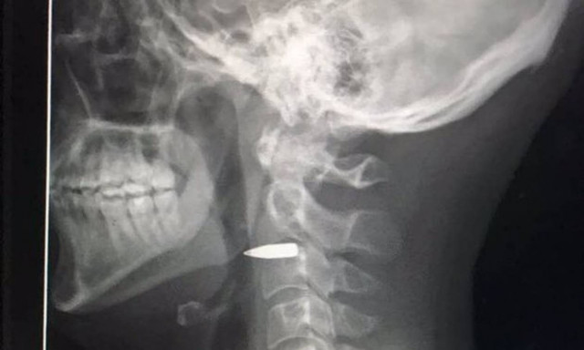 Σοκ: Αδέσποτη σφαίρα τραυμάτισε δημοσιογράφο στις Φιλιππίνες (pics)