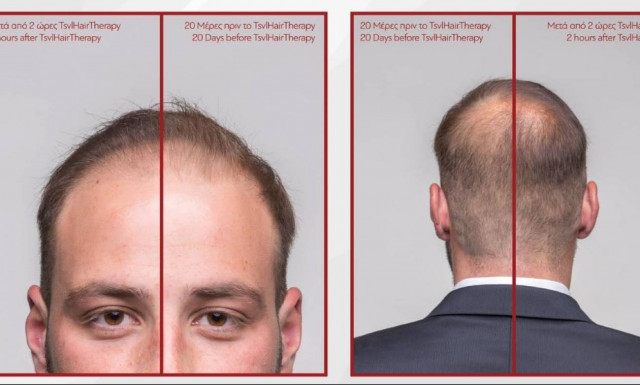 Έλληνας εξαλείφει την αραίωση των μαλλιών σε δύο ώρες