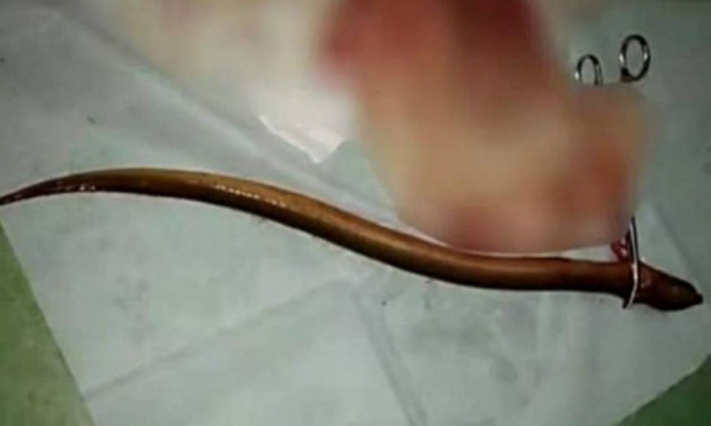 Αδιανόητο! Δε φαντάζεστε τι... έβαλε μέσα του για να καταπολεμήσει τη δυσκοιλιότητα (φωτογραφίες)