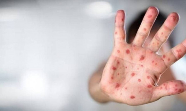 Greece facing widespread measles epidemic, disease control expert tells ANA