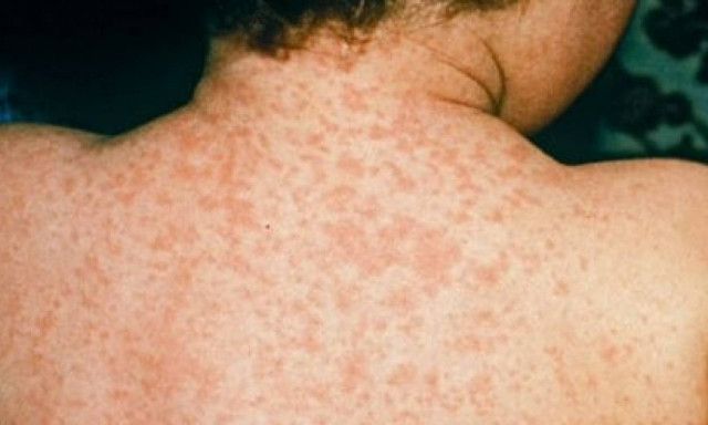 Όσα πρέπει να γνωρίζετε για την ιλαρά: Συχνές ερωτήσεις και απαντήσεις