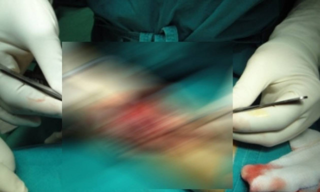 Συγκλονιστικό Βίντεο: Δείτε τι έβγαλαν οι γιατροί στο «Παίδων» από το στομάχι μιας 8χρονης