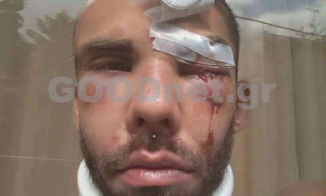 Σοκάρει ο άγριος ξυλοδαρμός φοιτητή στο Ρέθυμνο