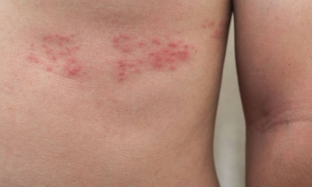 Ο έρπητας ζωστήρας μπορεί να εκδηλωθεί στον καθένα