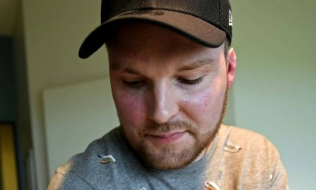 Συγκλονιστική ιστορία: Υπέστη εγκαύματα στο 95% του σώματός του - Πώς σώθηκε χάρη στον αδελφό του