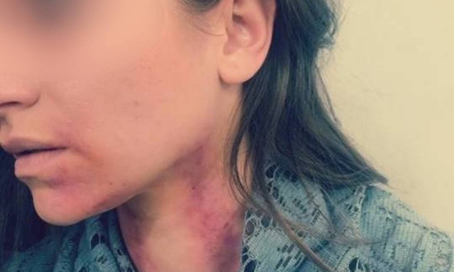 Η Ελληνίδα ηθοποιός, ο χωρισμός και οι εκδορές στο λαιμό - Τι συνέβη;