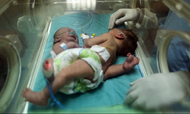 Συγκίνηση για τα σιαμαία κοριτσάκια που διαχωρίστηκαν έπειτα από τρεις μήνες ζωής (Pics)