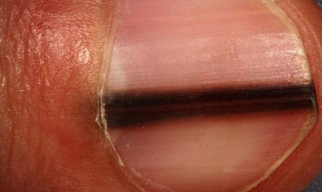 Προσοχή: Τι πρέπει να κάνετε αν δείτε αυτές τις γραμμές στα νύχια σας! (photos)