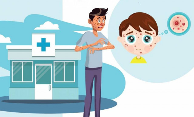 Ιλαρά: Πάνω από 3.220 τα κρούσματα – Καμπάνια του ΚΕΕΛΠΝΟ για την ανάγκη εμβολιασμού