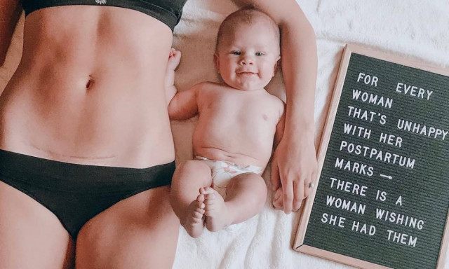 Εκπληκτικές φωτογραφίες με μαμάδες που δείχνουν το σημάδι της καισαρικής τομής (pics)