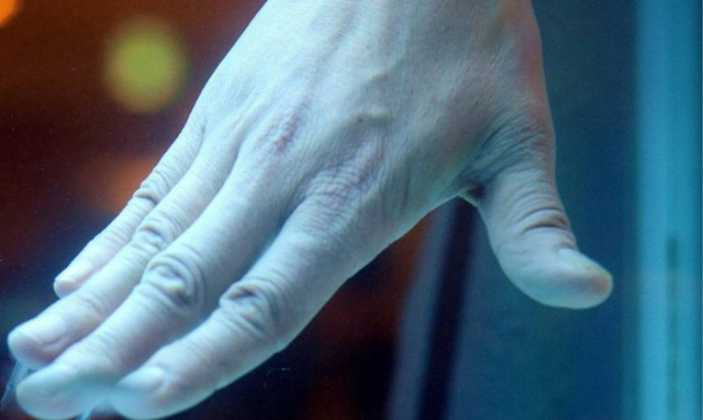 Ψωριασική αρθρίτιδα: Επικαιροποίηση της επισήμανσης για τη σεκουκινουμάμπη