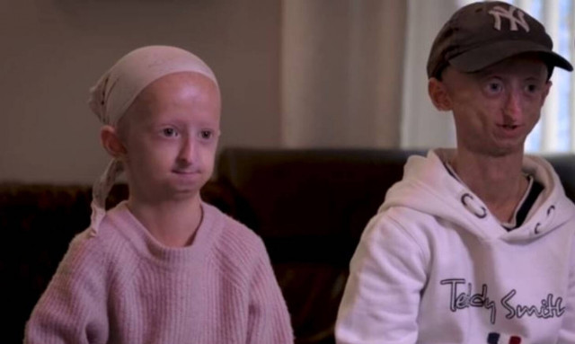 Τα δύο αδέρφια που γερνούν απότομα και δεν τα παρατάνε (vid)