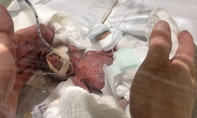 Θαύμα: Κέρδισε τη μάχη το βρέφος που γεννήθηκε μόλις 268 γραμμάρια!