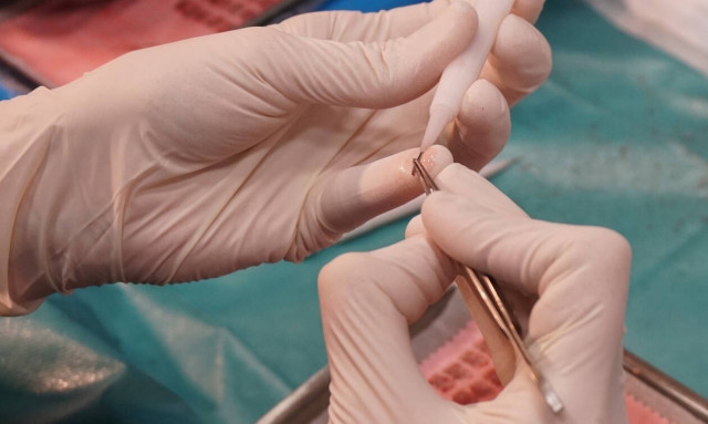 Τι πρέπει να προσέξεις πριν κάνεις μεταμόσχευση μαλλιών! 