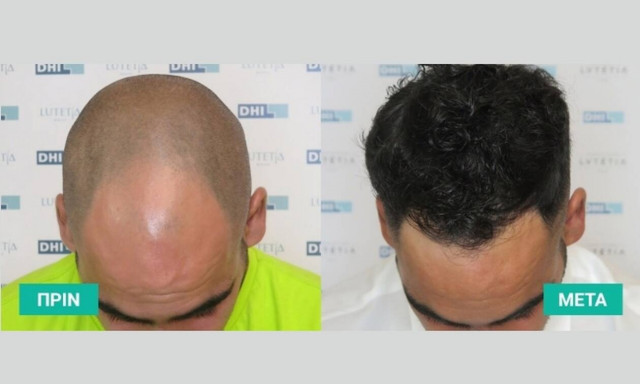 Ποια είναι η καλύτερη μεταμόσχευση μαλλιών στον κόσμο; 