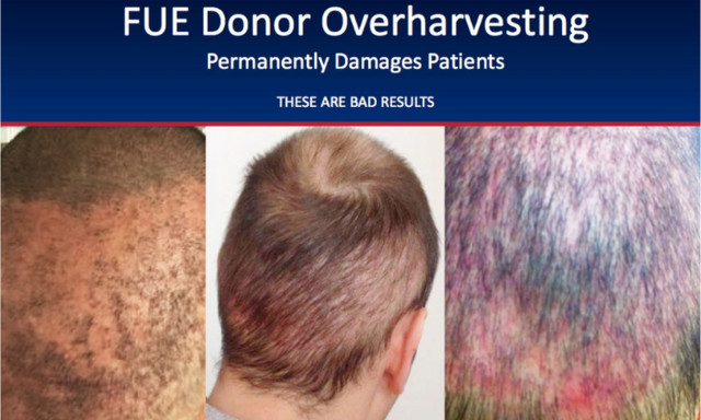 Συναγερμός για τις πειρατικές «κλινικές» μεταμόσχευσης μαλλιών