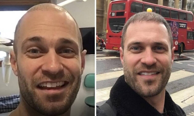 Τι έγινε όταν ένας Βρετανός ηθοποιός ταξίδεψε στην Ελλάδα για μεταμόσχευση μαλλιών (ΒΙΝΤΕΟ!)