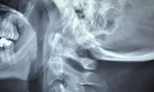 Πήγε στο νοσοκομείο γιατί δεν άκουγε καλά - Έπαθαν ΣΟΚ οι γιατροί όταν είδαν την ακτινογραφία