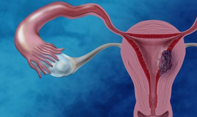 Kαρκίνος ενδομητρίου: 4 μύθοι που ανήκουν πλέον στο παρελθόν