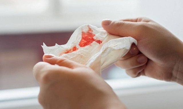 Ματώνει η μύτη σας; Δείτε τι μπορεί να πάθετε - «Πάγωσαν» οι γιατροί με αυτό που βρήκαν σε ασθενή