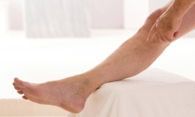 Κιρσοί: Ευάλωτα και τα ανδρικά πόδια σε αυτή τη συχνή φλεβική πάθηση 