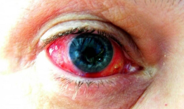 Απίστευτο! Αγοράκι έχει την ασθένεια του Δράκουλα - Ρέει συνεχώς αίμα από τα μάτια του