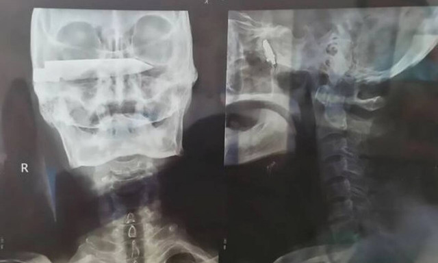 Έπαθαν ΣΟΚ οι γιατροί - Δείτε τι είχε στο κεφάλι του (pics)