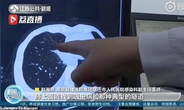 Έτρωγε ωμά φαγητά - Δείτε τι βρήκαν στους πνεύμονές του