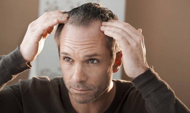 Μεταμόσχευση μαλλιών: Η κατάλληλη μέθοδος και το κόστος