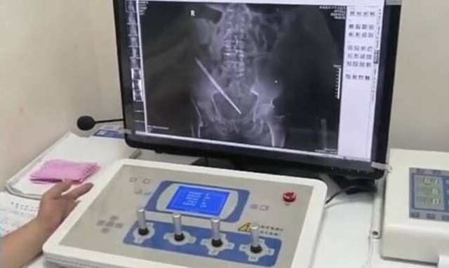 Είχε πόνους στην κοιλιά – «Πάγωσαν» οι γιατροί με αυτό που βρήκαν μέσα