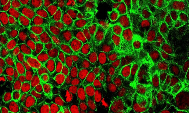 Ανοσο-ογκολογία: Νέα κλινικά οφέλη παρουσιάστηκαν στο ογκολογικό συνέδριο ASCO20 