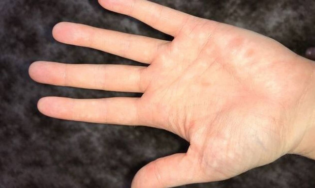 Έβγαλε εξανθήματα - Όταν τα είδε ο γιατρός έμαθε την φρικτή αλήθεια