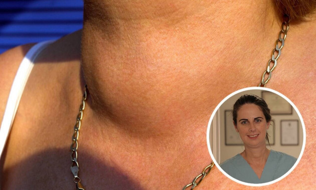 Βρογχοκήλη: Τι είναι και πώς αντιμετωπίζεται