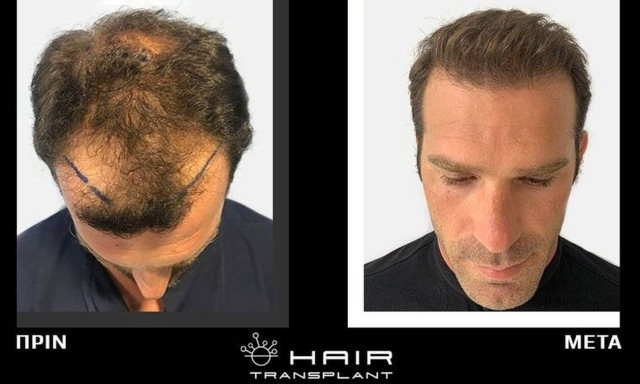 Η επανάσταση και το μέλλον της μεταμόσχευσης μαλλιών είναι οι συνδυαστικές τεχνικές FUE & Microstrip