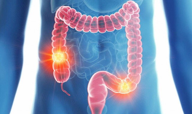 Δώρο ζωής η πρόληψη στον καρκίνο του Παχέος Εντέρου!