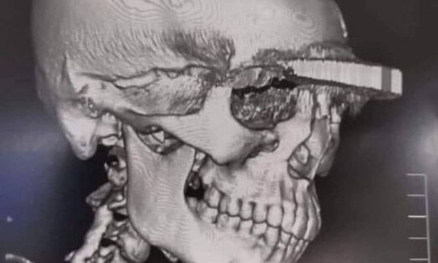 Φρίκη: Άνοιξε το κεφάλι της νυν του πρώην της με μπαλτά - Επέζησε από θαύμα