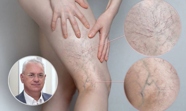 Φλεβική ανεπάρκεια: Γιατί δεν θα πρέπει να αμελούμε τη θεραπεία