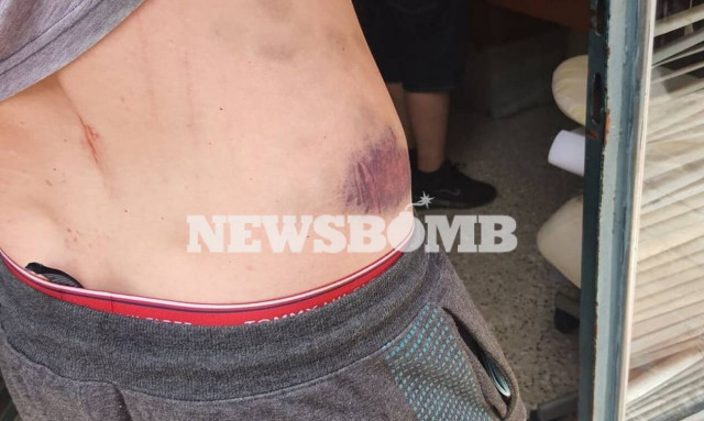 Καρέ - καρέ η τρομακτική επίθεση με ροτβάιλερ στο Μετς - «Θα φέρουμε μπράβους»