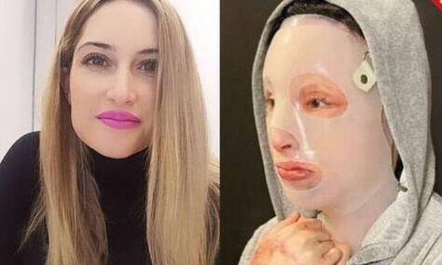 Επίθεση βιτριόλι -Συγκλονίζει η Ιωάννα: Όσα χρόνια κι αν καταδικαστεί, εγώ καταδικάστηκα περισσότερα