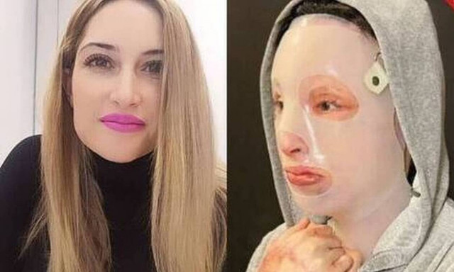 Επίθεση με βιτριόλι - Ιωάννα: «Θα βρεθώ στο δικαστήριο για να δει την καταστροφή που προκάλεσε»