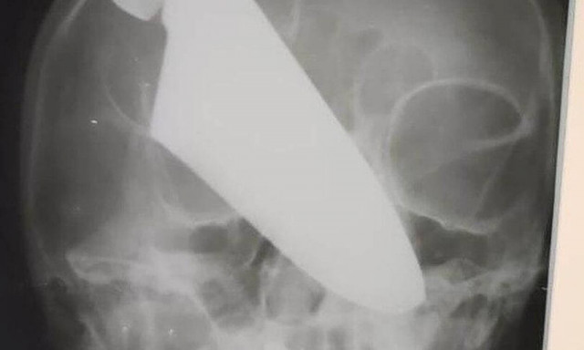 Ρωσία: Της κάρφωσε μαχαίρι στη μύτη και επέζησε - Απίστευτες εικόνες