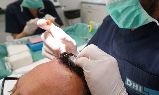 Μεταμόσχευση μαλλιών… χωρίς κούρεμα!