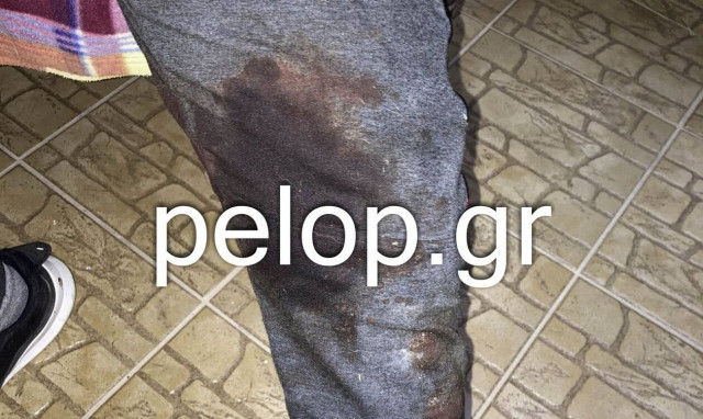 Πάτρα: «Eφιάλτης» για οικογένεια που δέχθηκε επίθεση από πιτμπουλ - Κινδύνευσε μωρό