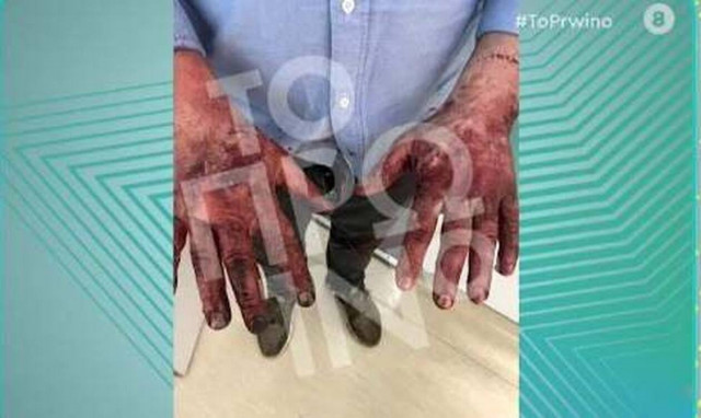 Τζώρτζης Μονογυιός: Συγκλονιστικές εικόνες με τα εγκαύματα του φίλου του που τον απεγκλώβισε