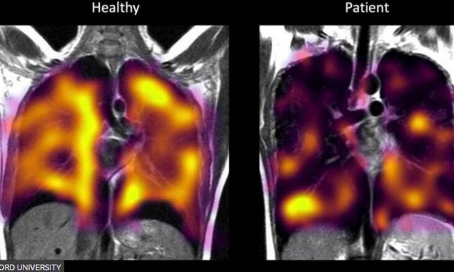 Long Covid: «Κρυφή» βλάβη στους πνεύμονες των ασθενών δείχνει νέα έρευνα - Φως στο μυστήριο