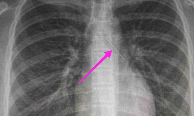 Θεσσαλονίκη: Ανήλικη κατάπιε καρφίτσα – Την έσωσαν οι γιατροί του «Ιπποκρατείου»