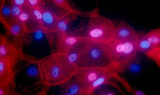 Αντικαρκινική ανοσοθεραπεία συνδέεται με 10ετή ύφεση σε δύο ασθενείς με λευχαιμία