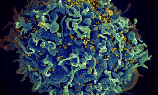 Ένα εξαιρετικά λοιμογόνο, αλλά θεραπεύσιμο, στέλεχος HIV κυκλοφορεί αθόρυβα από τη δεκαετία του '90